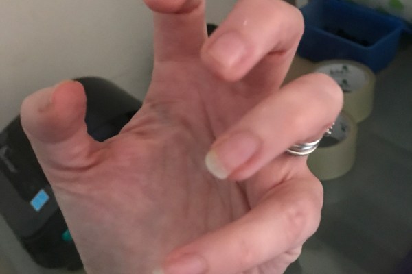 My left hand, frozen and unable to move