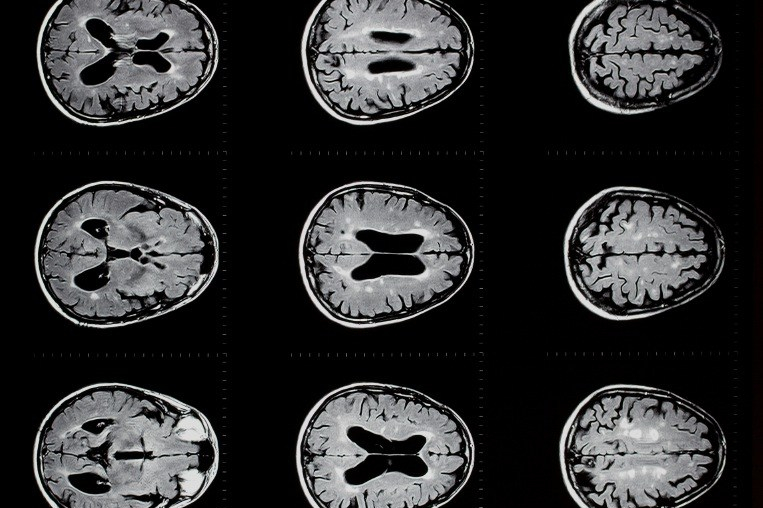 An MRI scan of a brain
